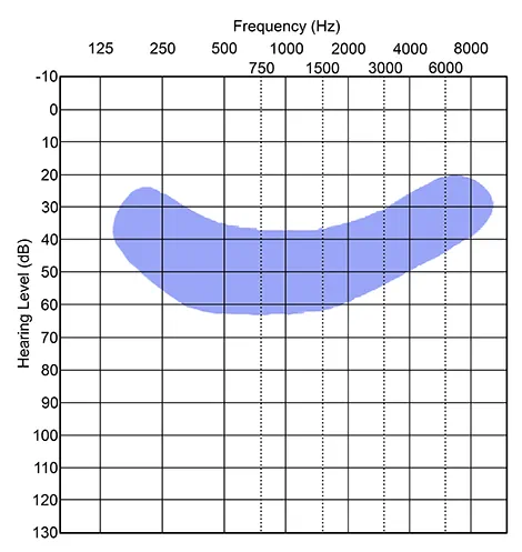 dB ve frekans değerlerini gösteren bir odyogram